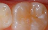 Pediatric Dentist - Tooth  Before Sealant Application