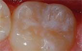 Pediatric Dentist - Tooth After Sealant Application